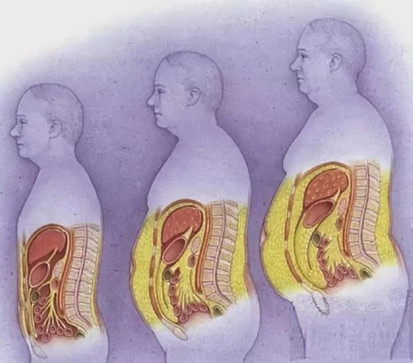 内脏脂肪对比.jpg 内脏脂肪对比.jpg